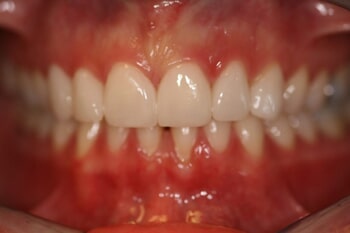 Veneers After